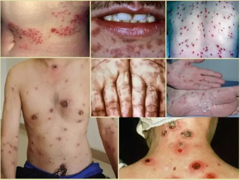 Dấu hiệu nhận biết bệnh giang mai 2