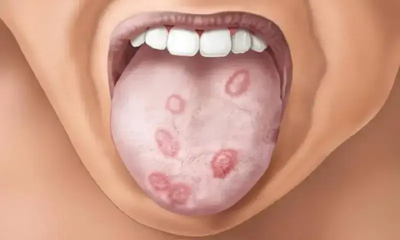 Nguyên nhân gây bệnh giang mai và cơ chế lây lan 1