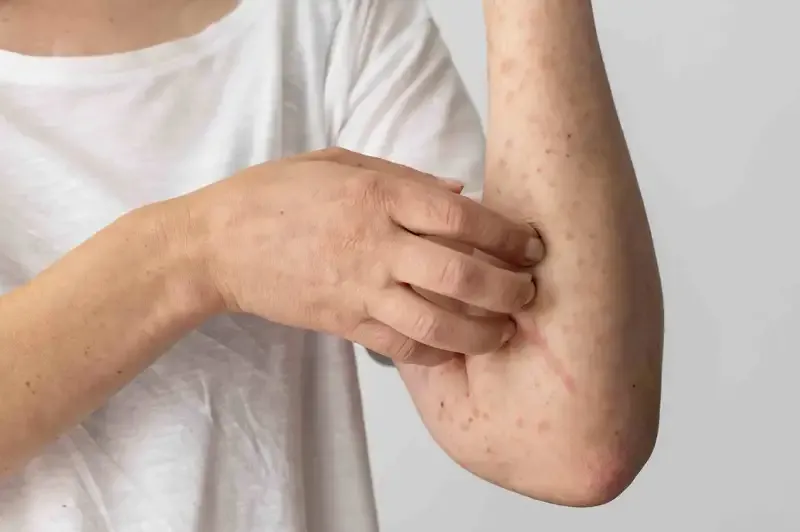 Nguyên nhân gây bệnh giang mai và cơ chế lây lan 2