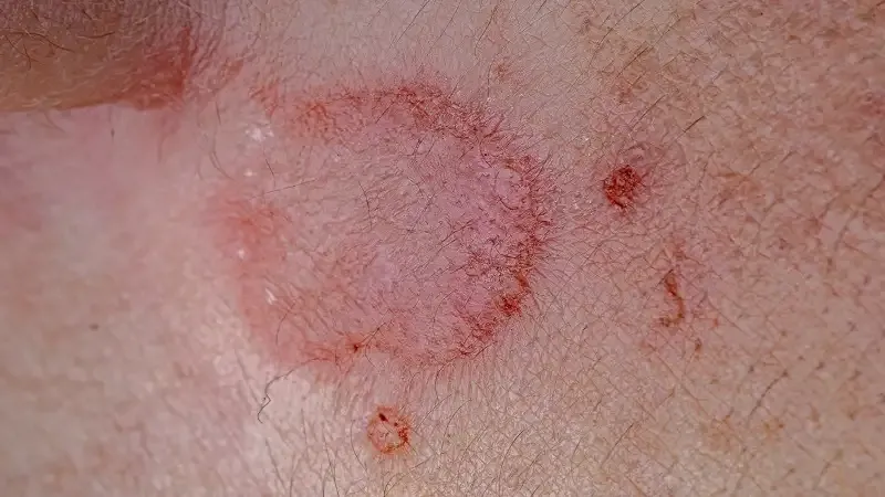 Biến chứng nguy hiểm của giang mai