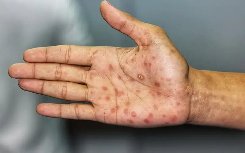 Xét nghiệm chẩn đoán giang mai