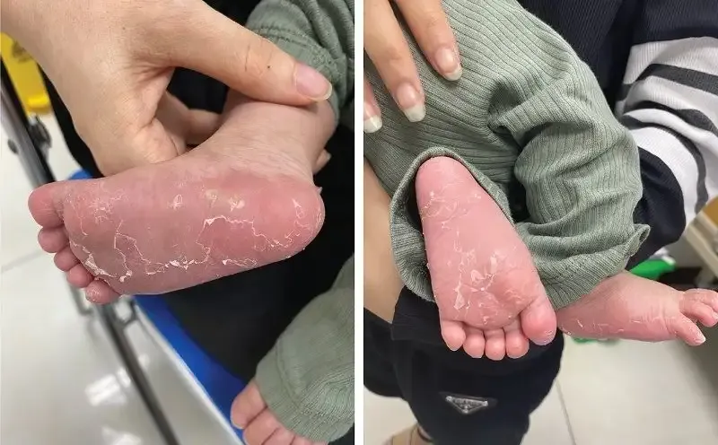 Cách phòng ngừa bệnh giang mai 1