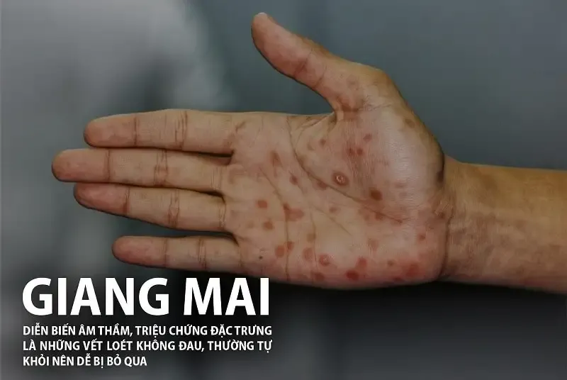 Cách phòng ngừa bệnh giang mai 2