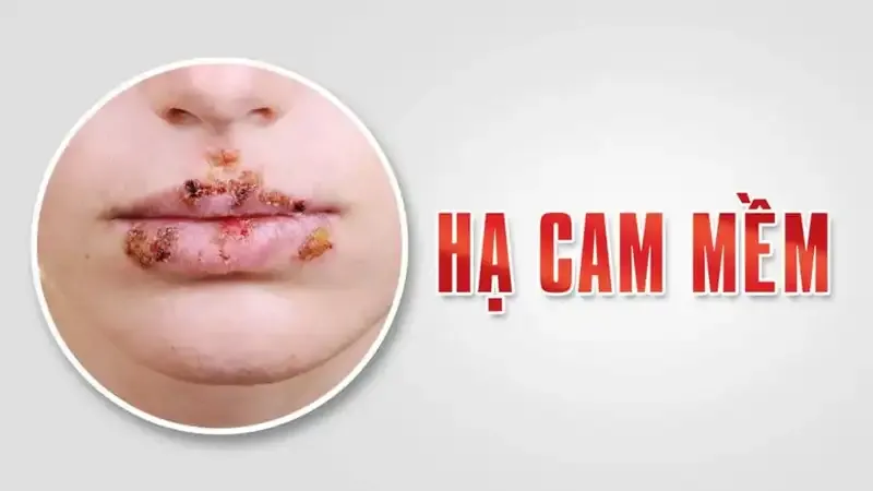 Cách phòng ngừa bệnh bệnh hạ cam 3