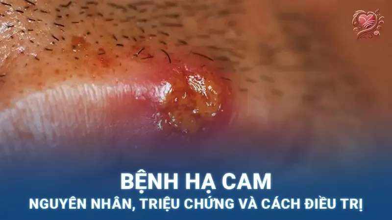 Bệnh hạ cam là gì?