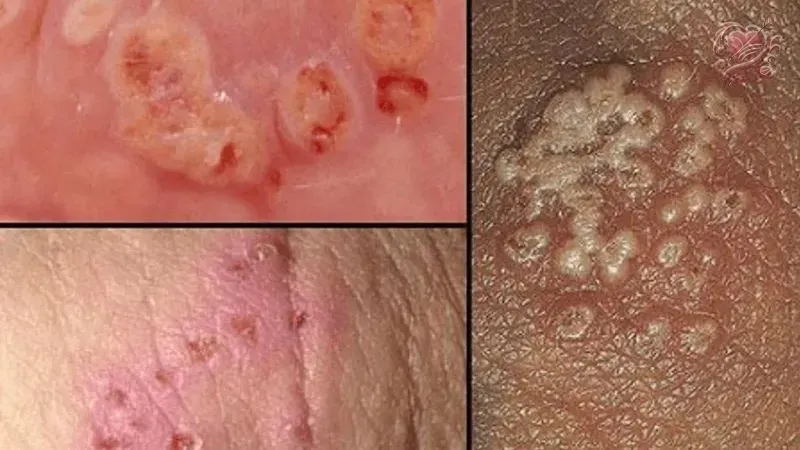 Herpes sinh dục là gì?