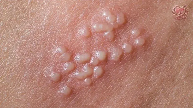 Herpes sinh dục nguy hiểm như thế nào?