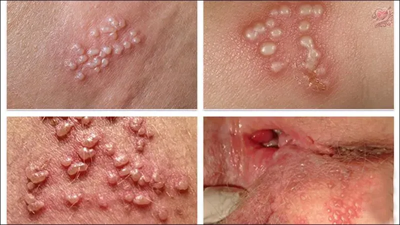 Herpes sinh dục nguy hiểm như thế nào?