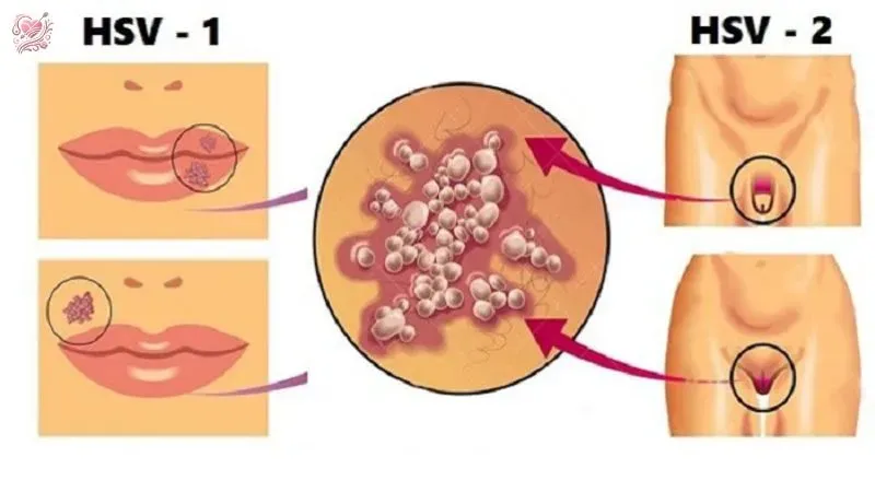 Phương pháp chẩn đoán Herpes sinh dục