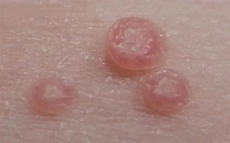 Nguyên nhân gây bệnh hột xoài