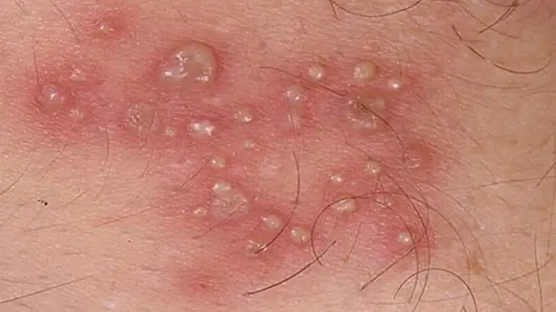 Chẩn đoán bệnh hột xoài  1
