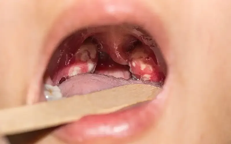 Điều trị bệnh lậu cầu 1