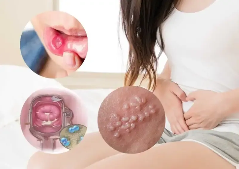 Điều trị bệnh lậu cầu 2