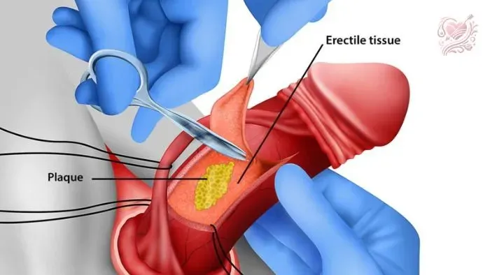 Chế độ sinh hoạt phòng ngừa bệnh peyronie