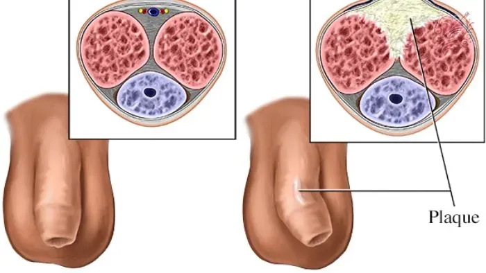 Chế độ sinh hoạt phòng ngừa bệnh peyronie