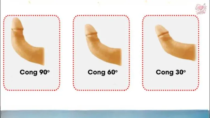 Phương pháp chẩn đoán & điều trị bệnh peyronie
