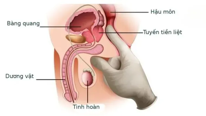Triệu chứng bệnh Peyronie