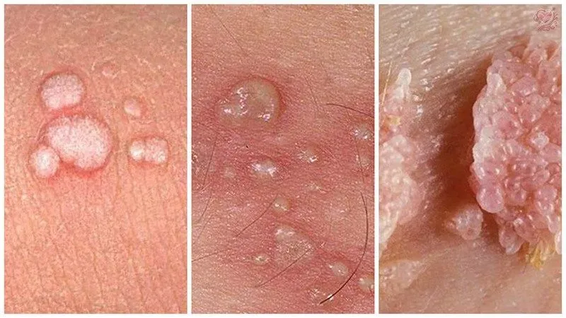 Hậu quả của bệnh tình dục ở nam