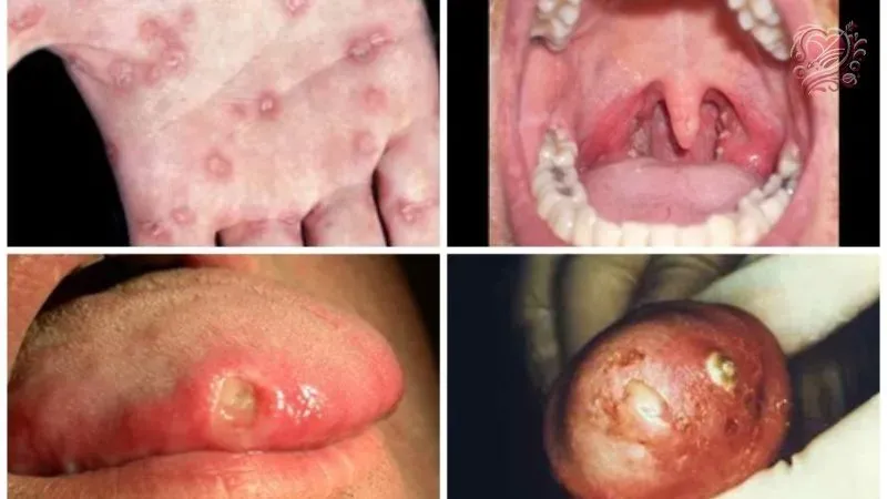 Các yếu tố nguy cơ bị bệnh tình dục nam