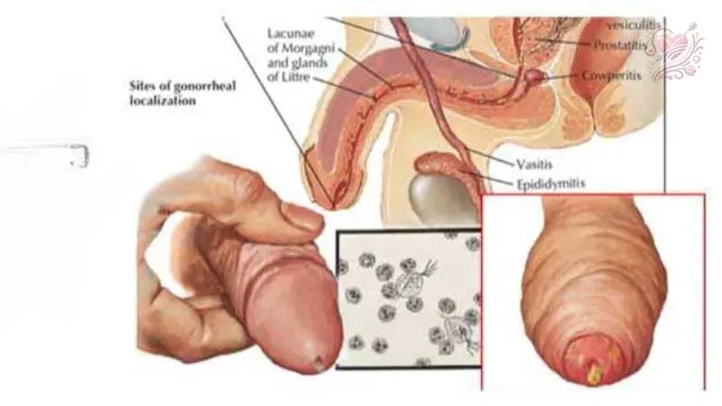 Nguyên nhân gây bệnh tình dục ở nam