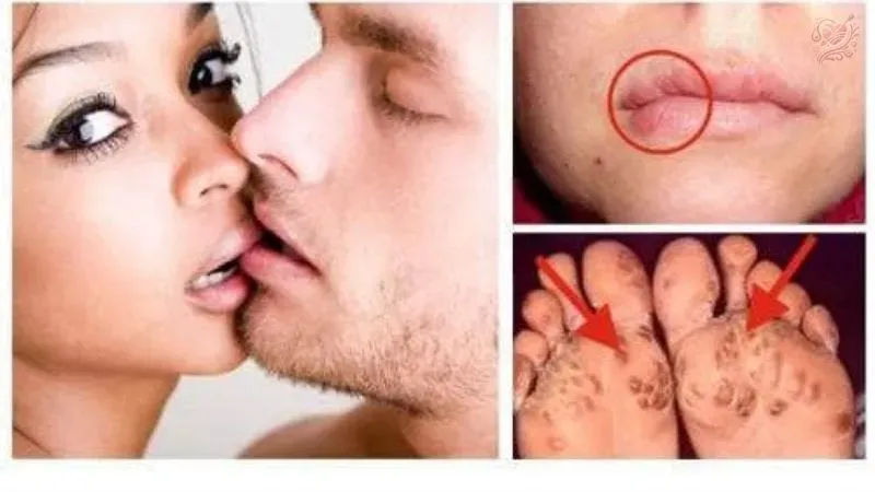 Bệnh tình dục ở nam là gì?