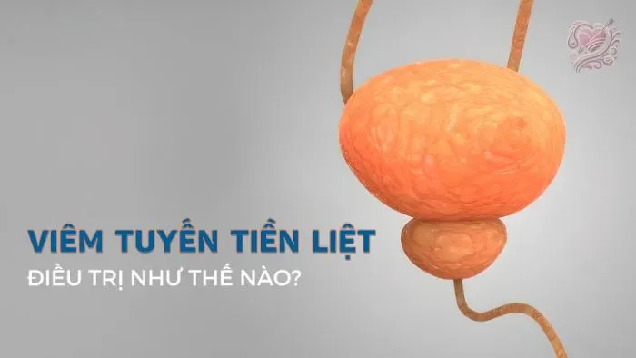 Điều trị viêm tuyến tiền liệt