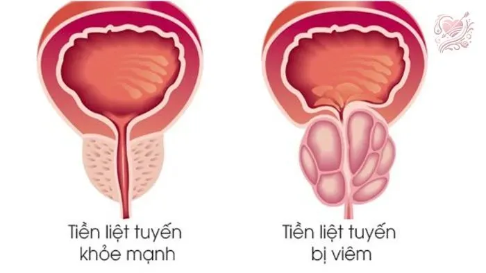 Các biện pháp chẩn đoán viêm tuyến tiền liệt