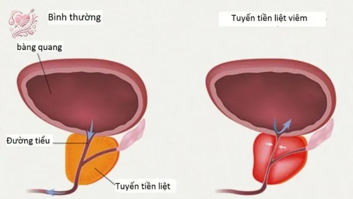 Đối tượng có nguy cơ mắc bệnh viêm tuyến tiền liệt?