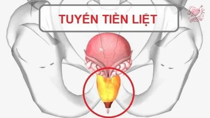 Các dạng viêm tuyến tiền liệt 