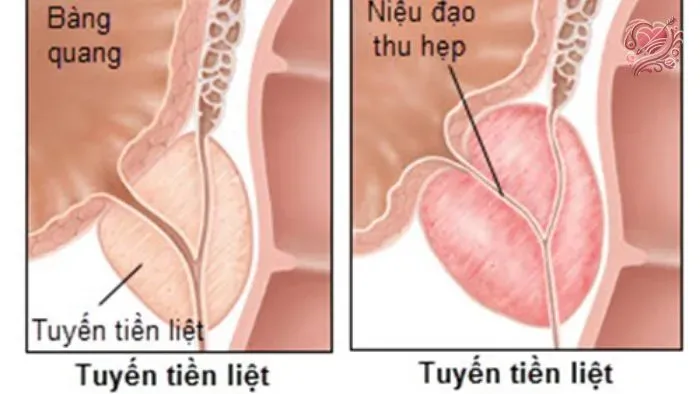 Dấu hiệu bệnh viêm tuyến tiền liệt