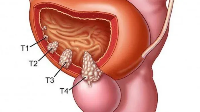 Bệnh viêm tuyến tiền liệt là gì?