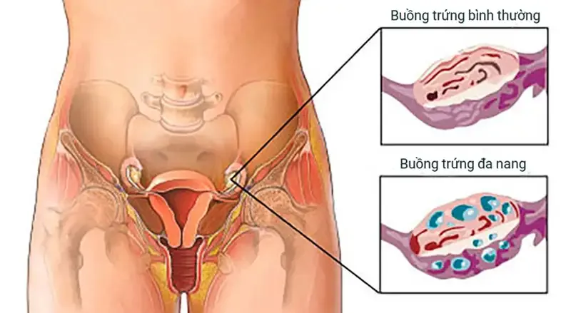 Triệu chứng thường gặp của đa nang buồng trứng 2
