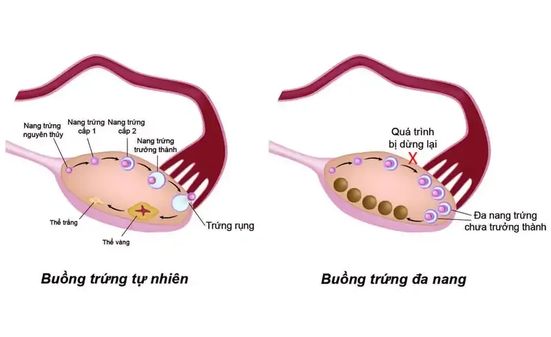 Chẩn đoán buồng trứng đa nang 1