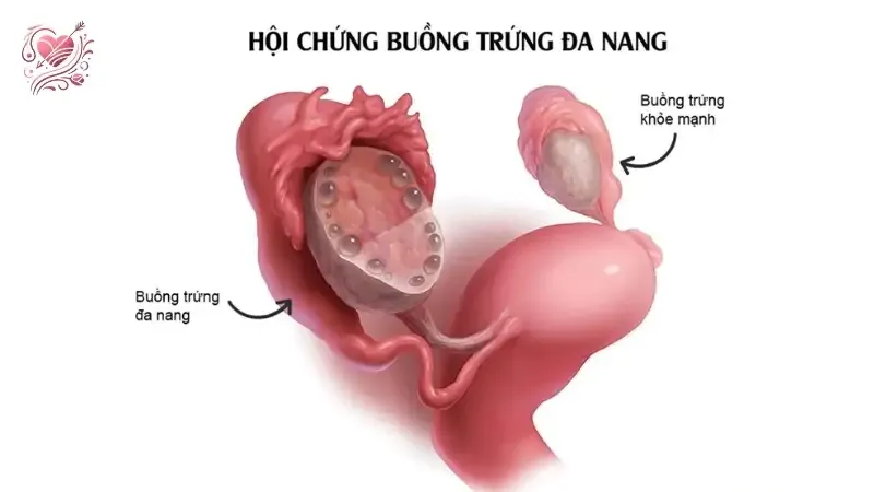 Cách phòng tránh bệnh đa nang buồng trứng 2