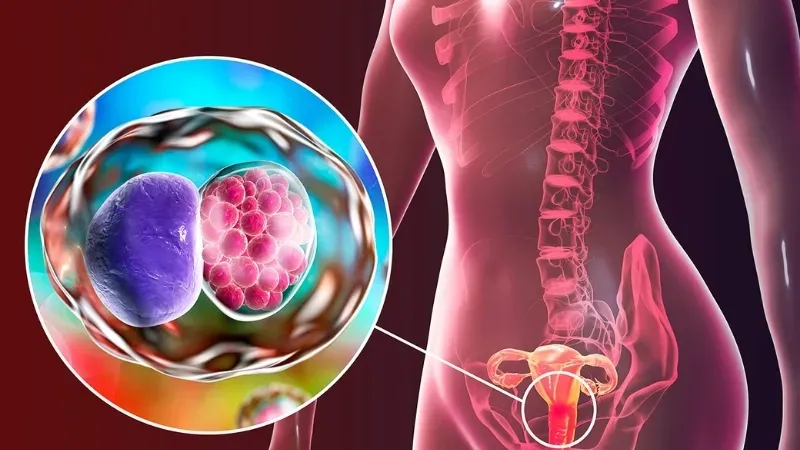 Viêm âm đạo do vi khuẩn