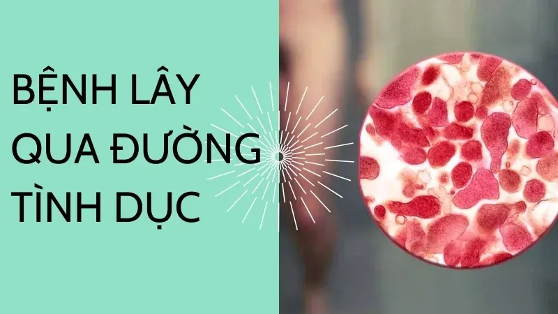  Bệnh lây qua đường tình dục (STD) là gì?