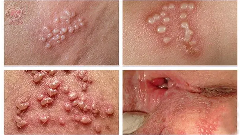 Cách phòng ngừa bệnh lây truyền qua đường tình dục