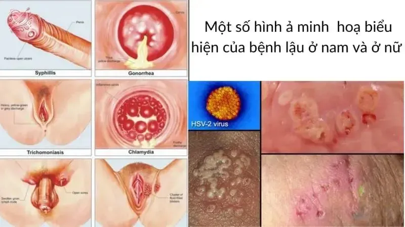 Định nghĩa bệnh lây truyền qua đường tình dục 