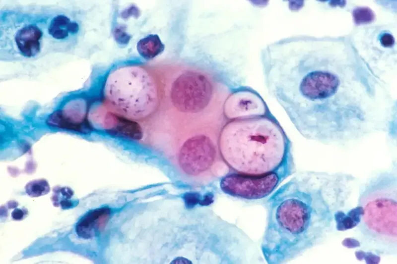 Bệnh Chlamydia là gì?