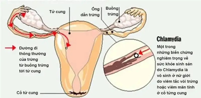 Nguyên nhân gây bệnh Chlamydia 1