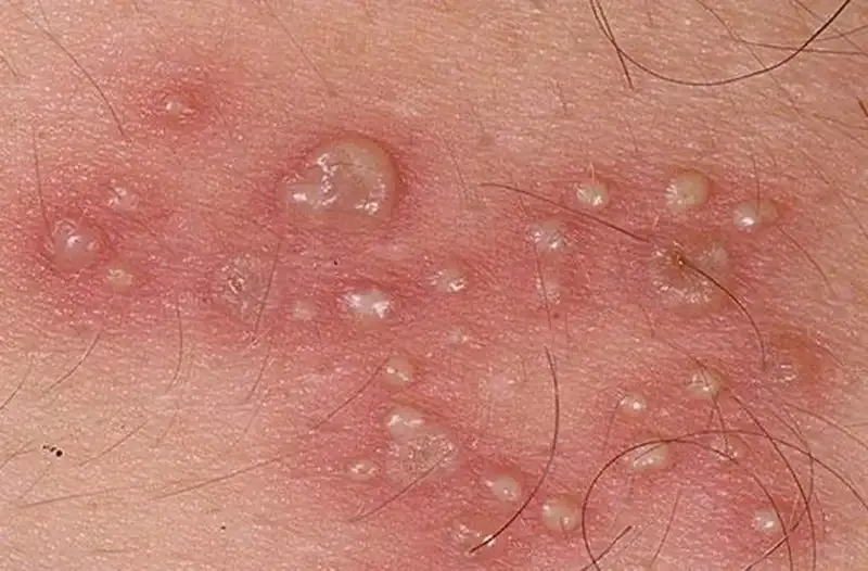 Nguyên nhân gây bệnh Chlamydia 2