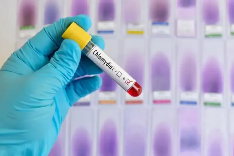 Phương pháp chẩn đoán bệnh Chlamydia