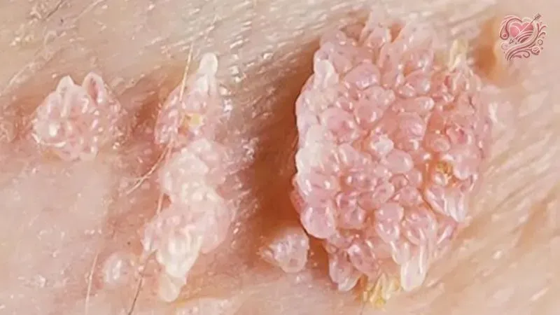 Nguyên nhân gây bệnh tình dục ở nữ