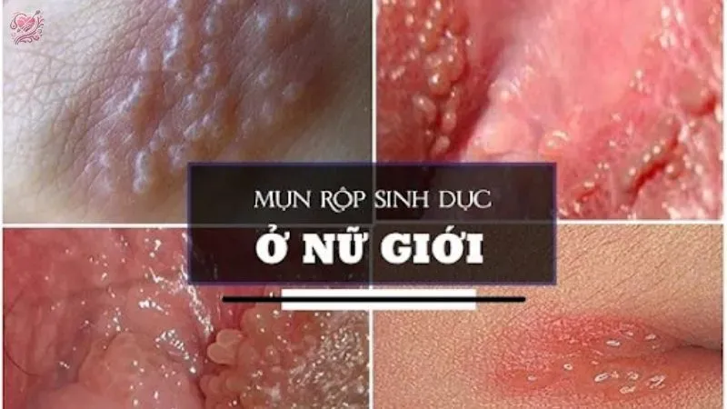 Dấu hiệu nhận biết bệnh tình dục ở nữ giới 