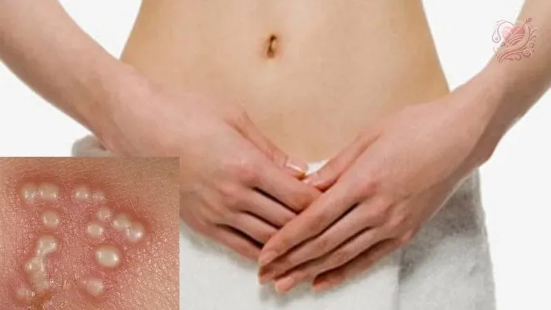 Dấu hiệu nhận biết bệnh tình dục ở nữ giới 
