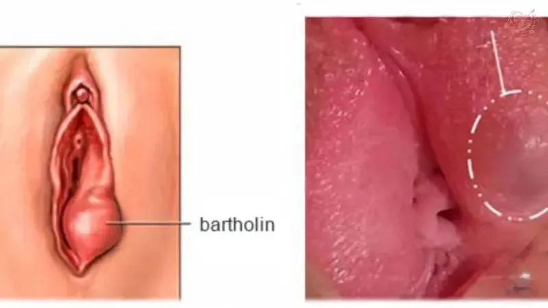 Bệnh tình dục ở nữ là gì?