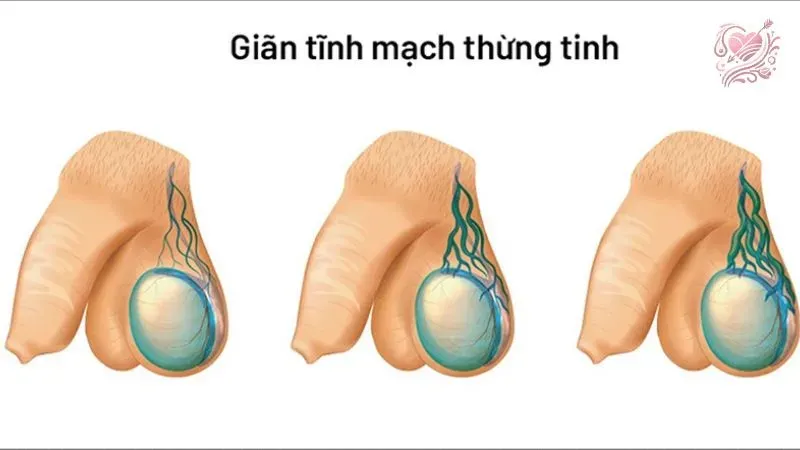 Phòng ngừa vô sinh ở tuổi dạy thì nam