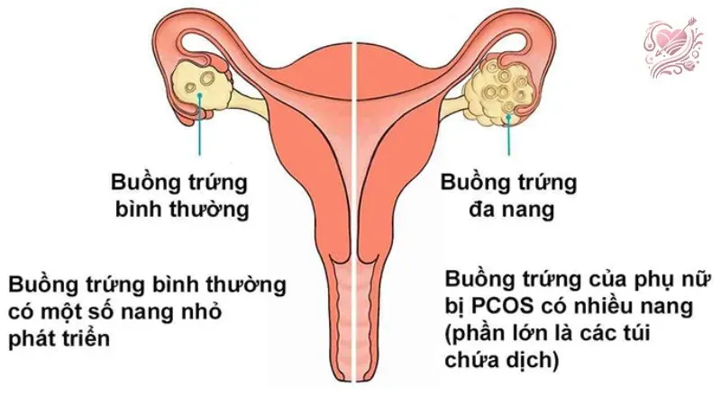 Phương pháp điều trị vô sinh ở nữ 