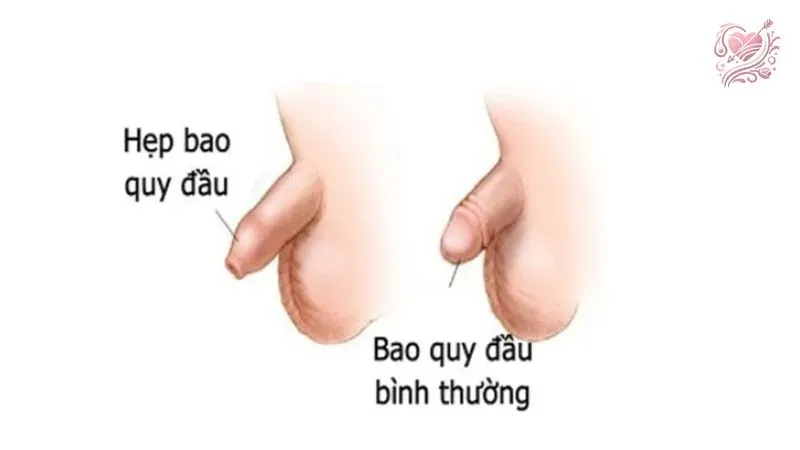 Khi nào nên nong bao quy đầu cho trẻ