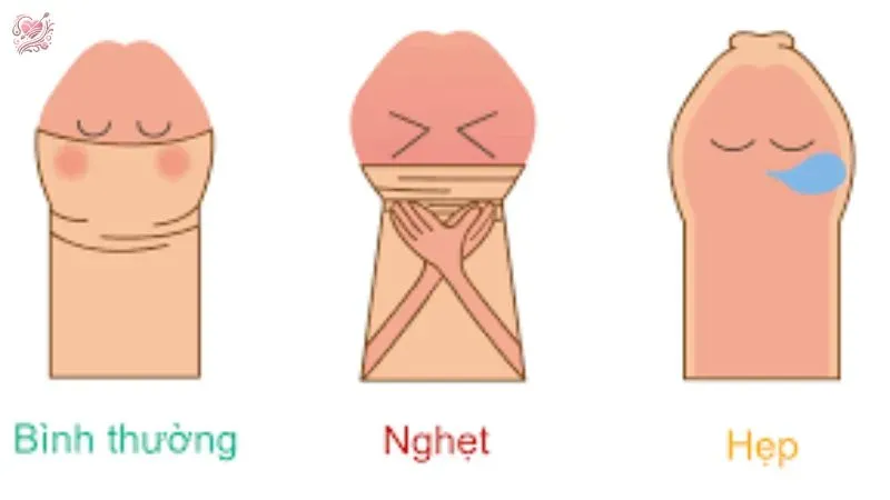 Triệu chứng của hẹp bao quy đầu